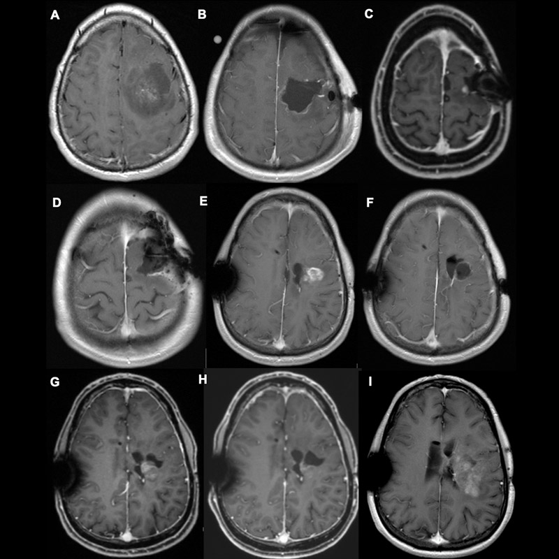 9 MRI images of a glioblastoma that was treated and monitored over 6 years