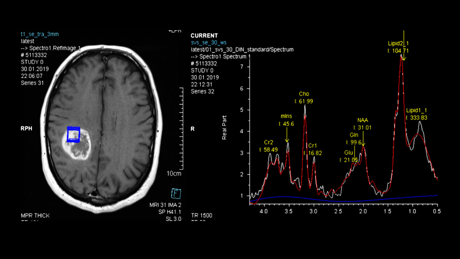 MR spectroscopy image with analysis