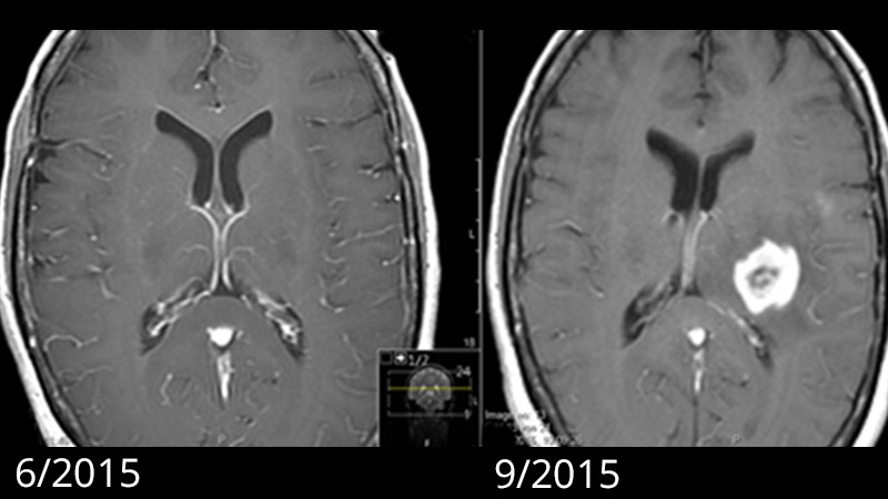 MRI images of the growth of a glioblastoma at 12-week intervals