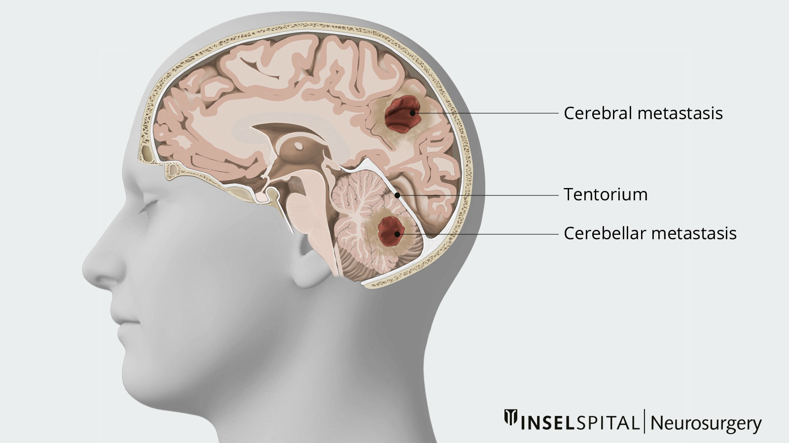 Skull drawing for localization of brain metastases