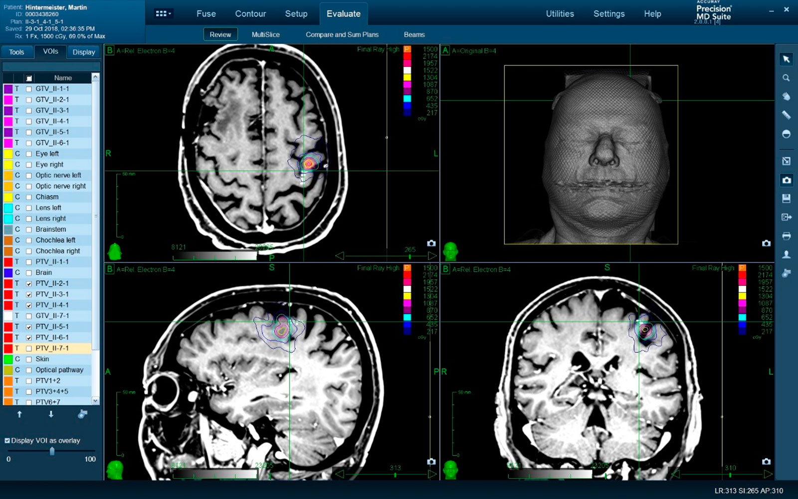 Illustration of a radiosurgical treatment plan with nTMS.