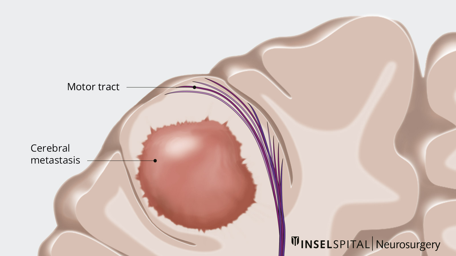 Drawing of a brain metastasis with infiltration into surrounding tissue.