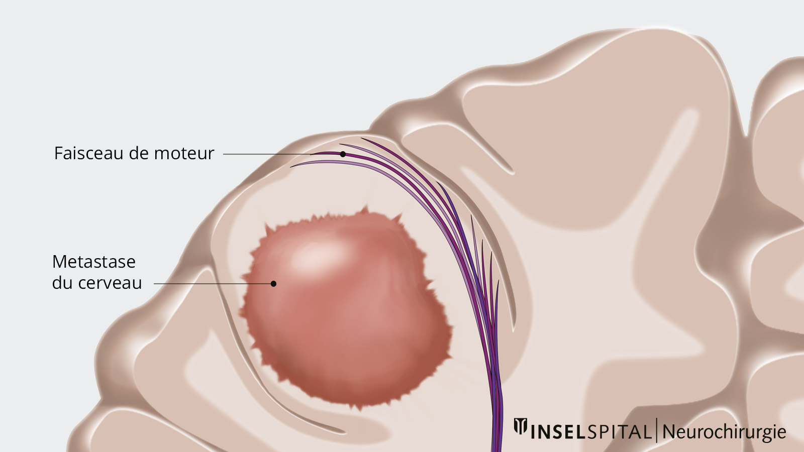 Dessin d'une métastase cérébrale avec infiltration dans les tissus environnants