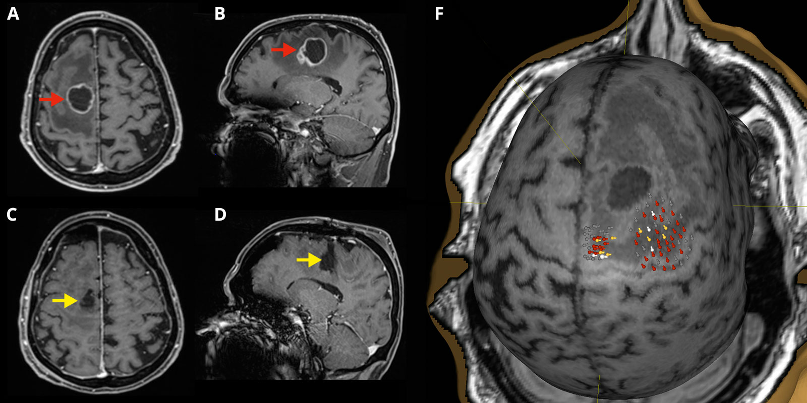 MRI images and nTMS images to localize the motor center before surgery.