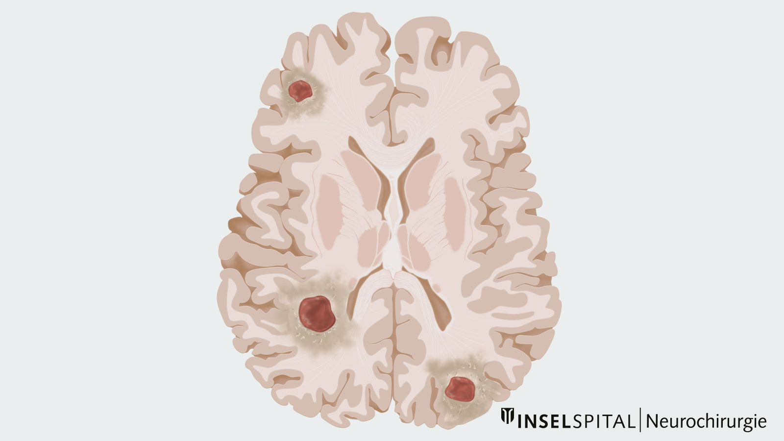 Dessin de plusieurs métastases cérébrales