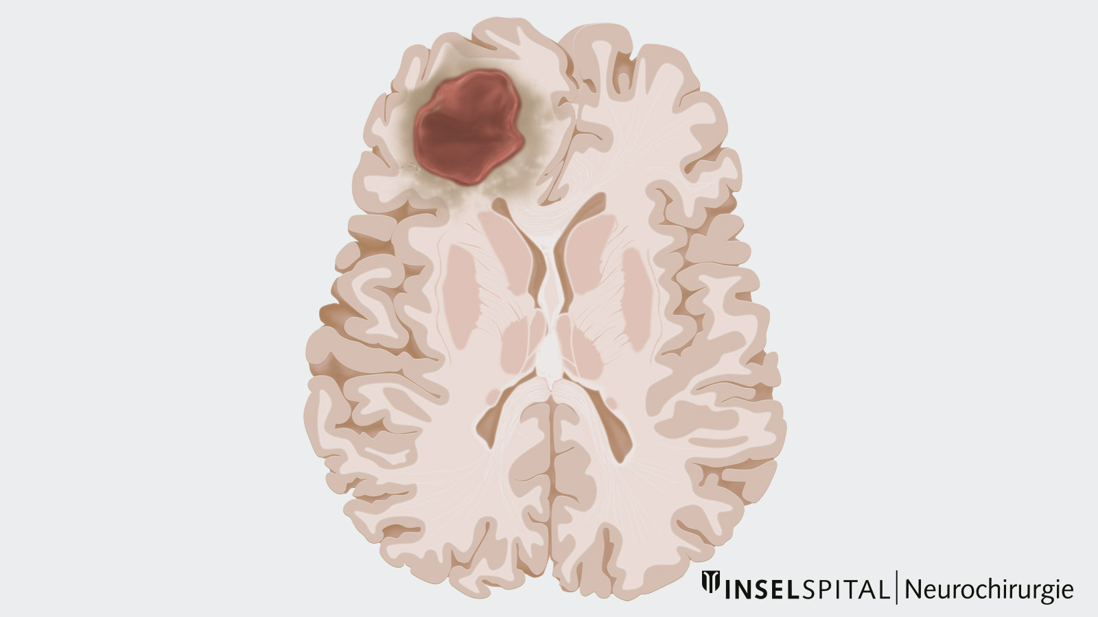 Dessin d'une seule métastase dans le cerveau