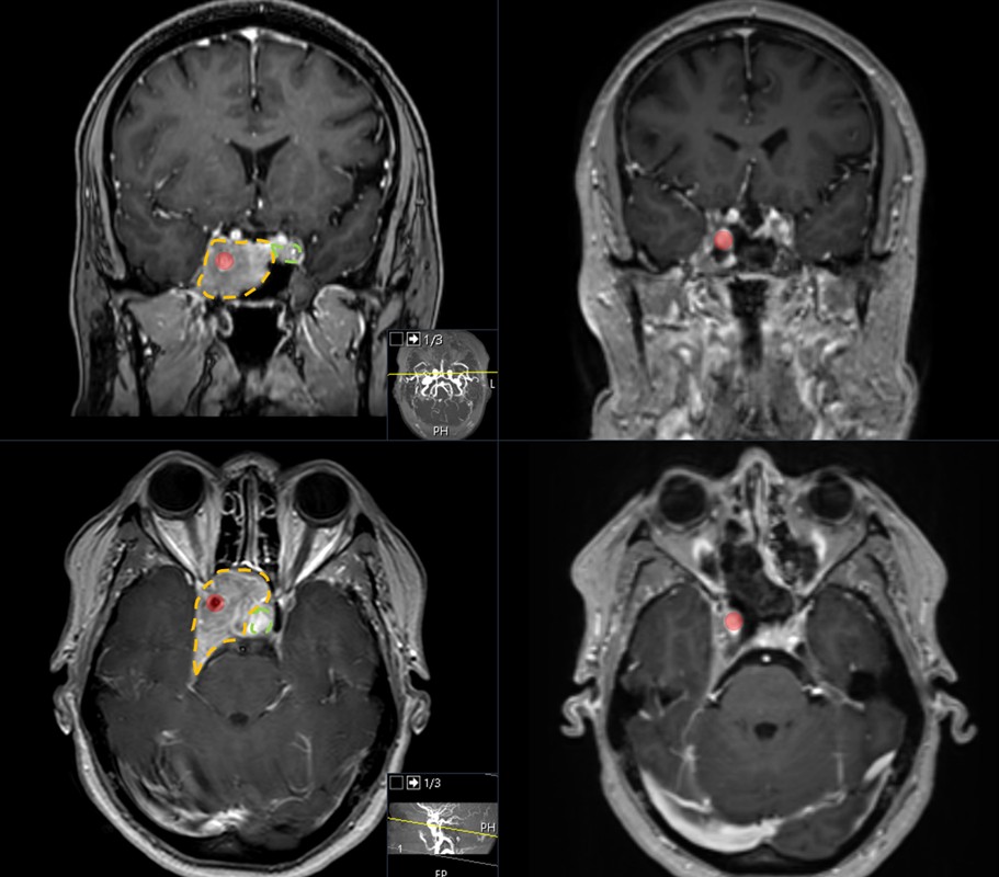MRT eines Hypophysenadenoms, das die Arteria carotis interna umschliesst