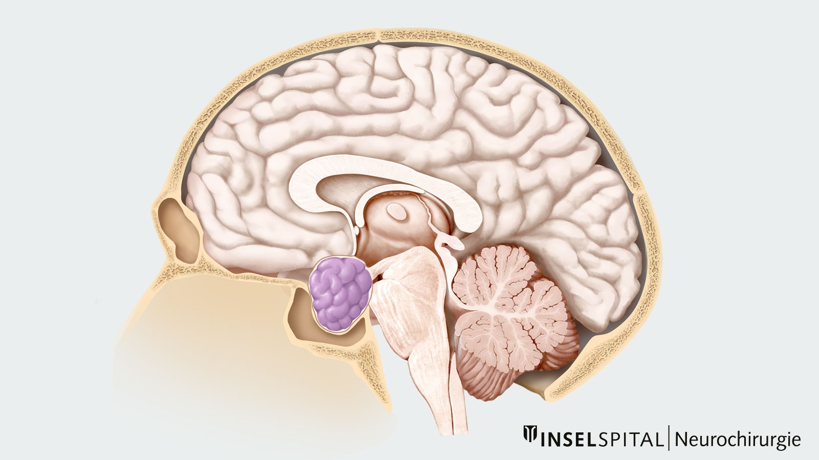 Dessin d'une coupe transversale du crâne avec adénome hypophysaire marqué en couleur