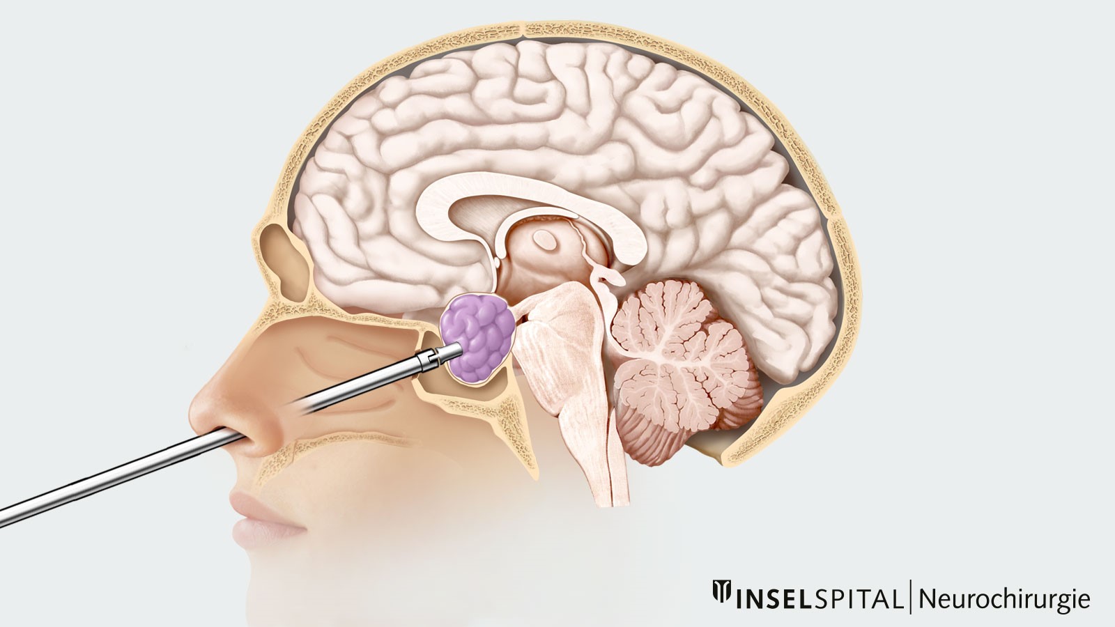 Farbzeichnung zum transnasalen transsphenoidalen Zugang über die Nase zum Hypophysenadenom