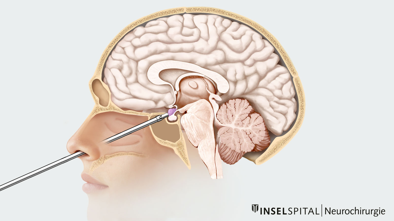 Dessin en couleur pour l'accès transnasal transsphénoïdal à la tumeur par le nez