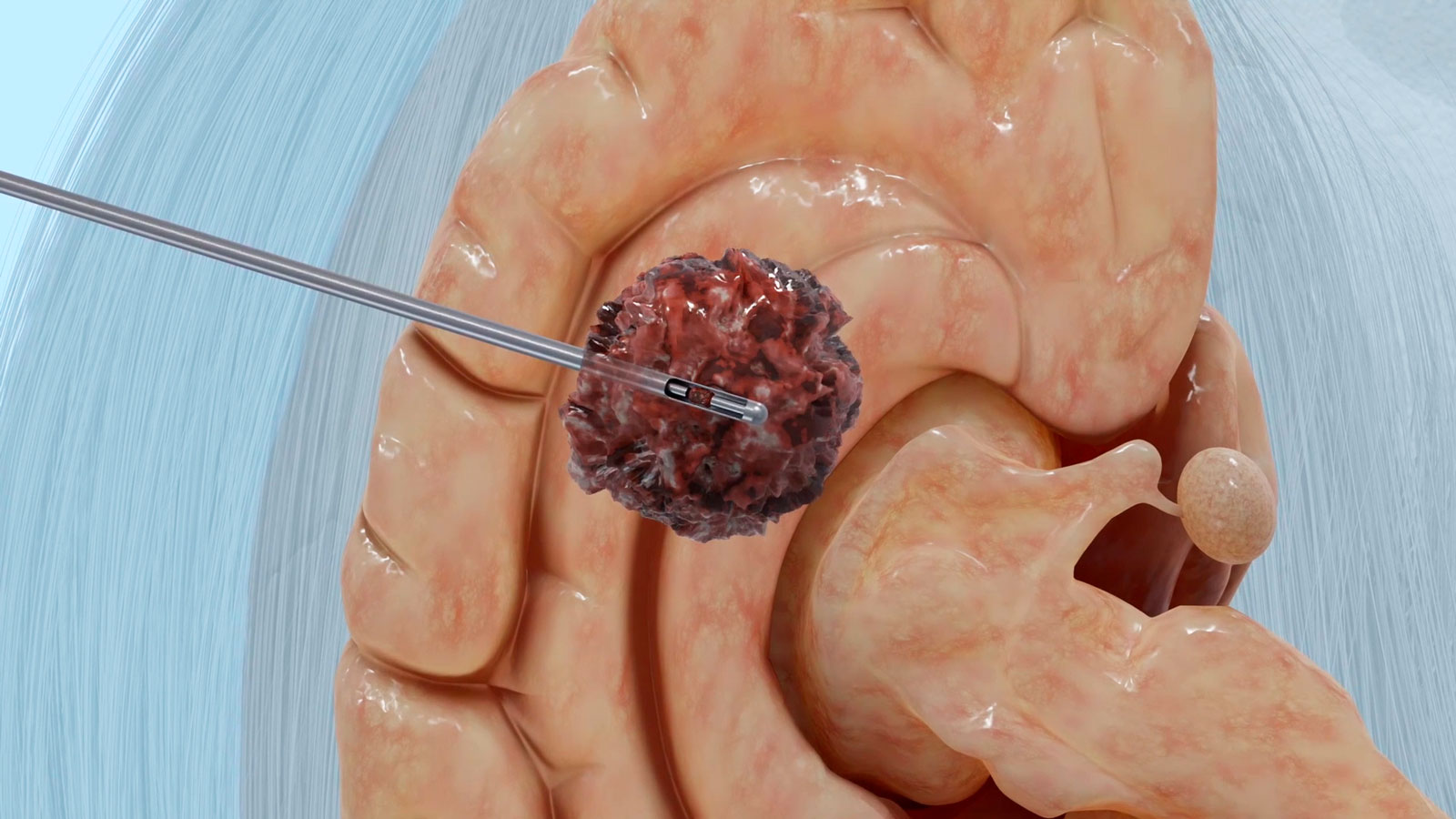 Schematic illustration of a tissue biopsy for a brain tumor