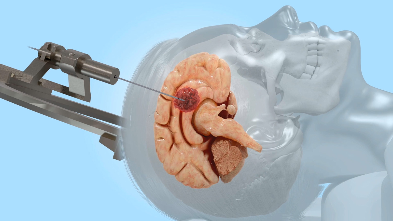 Schematic representation of a stereotactic biopsy