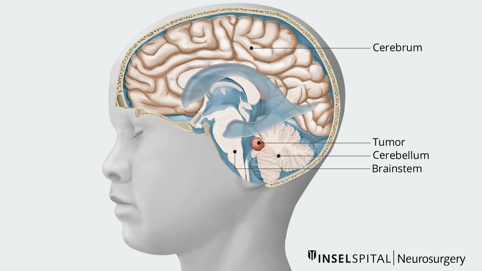 Drawing of the skull in cross-section with cerebrum, cerebellum, brain stem and tumor