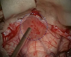 Operationsfoto. Der Tumor ist kreisförmig markiert.