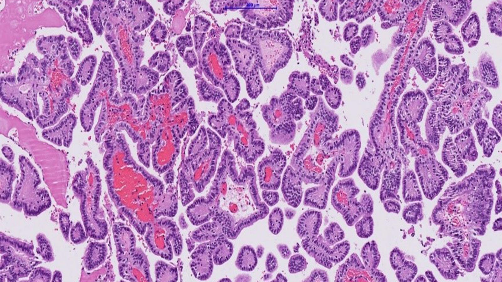 Histopathologic photomicrograph of a plexus papilloma