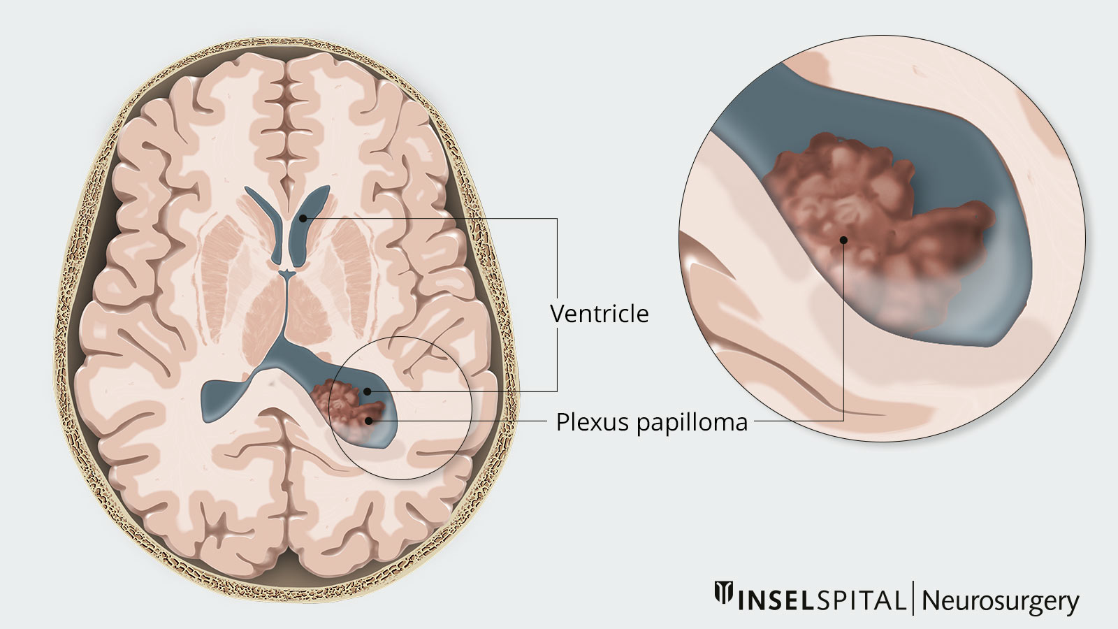 Two-part drawing for localization of a plexus papilloma in the ventricle