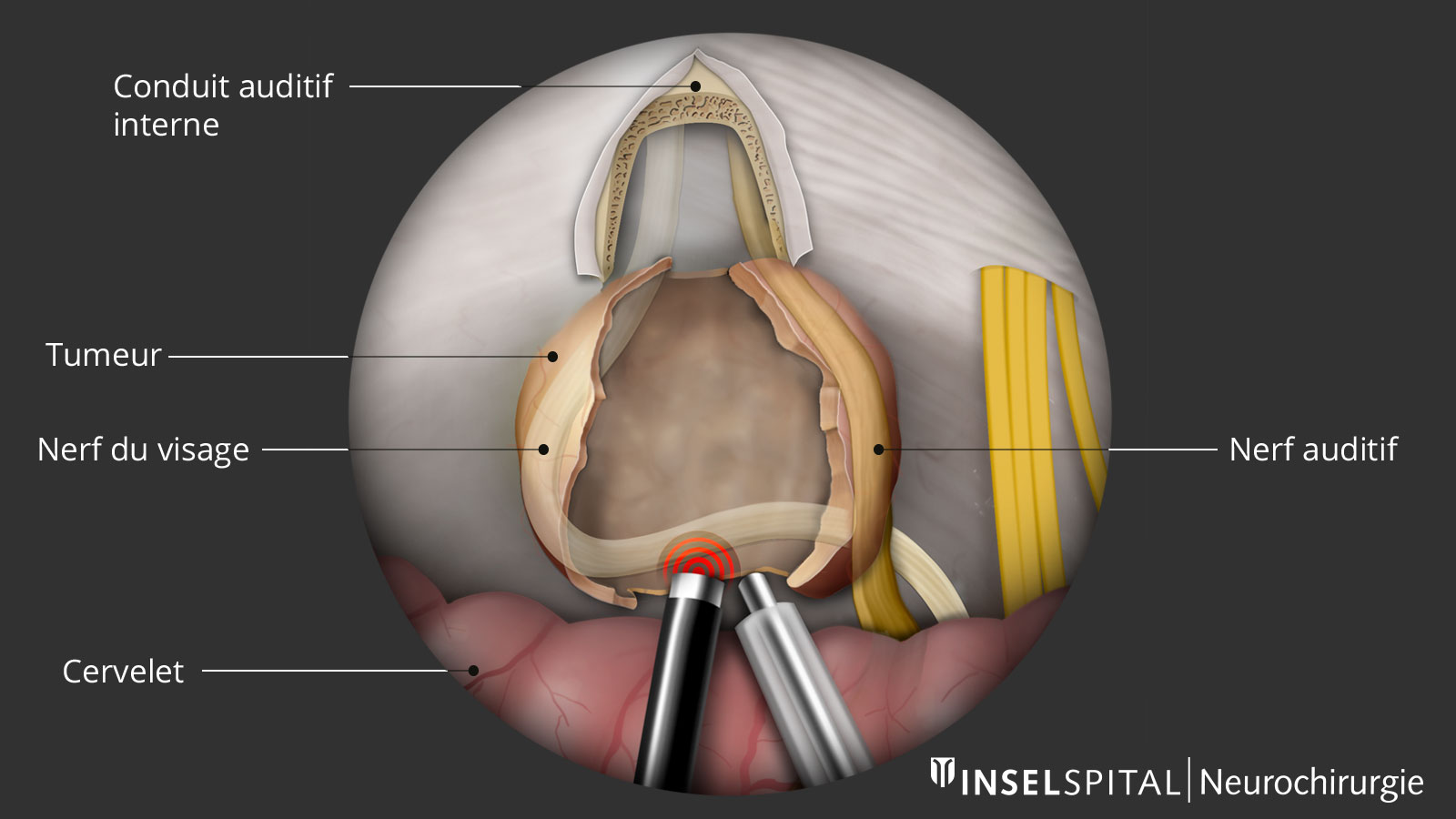 Dessin du fonctionnement du monitoring neurophysiologique