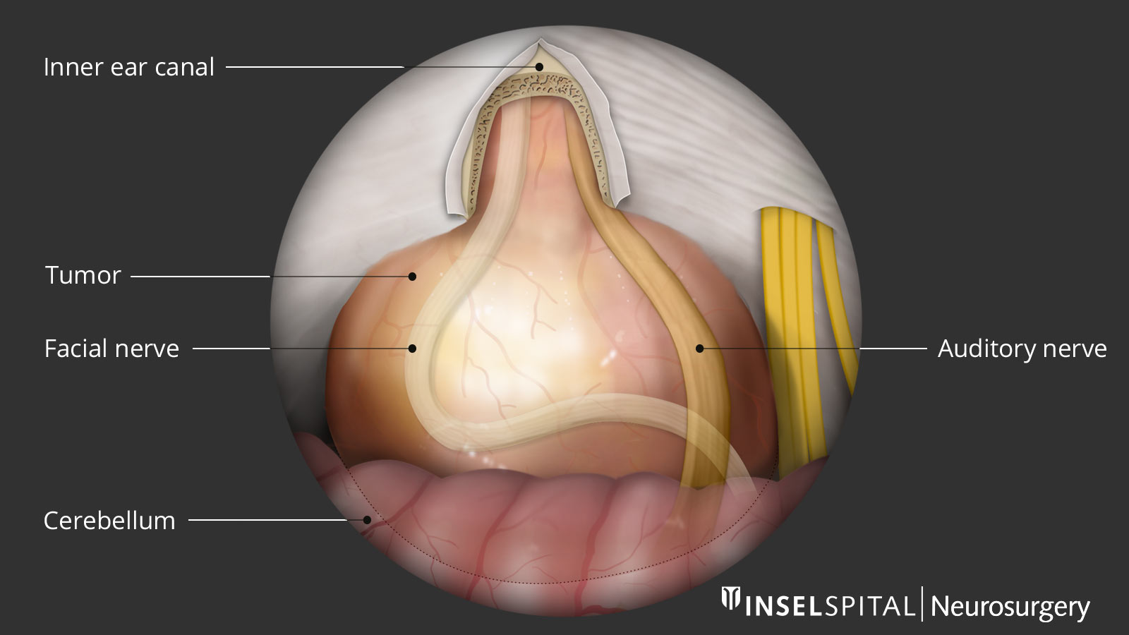 Drawing of a vestibular schwannoma from the surgeon's point of view.