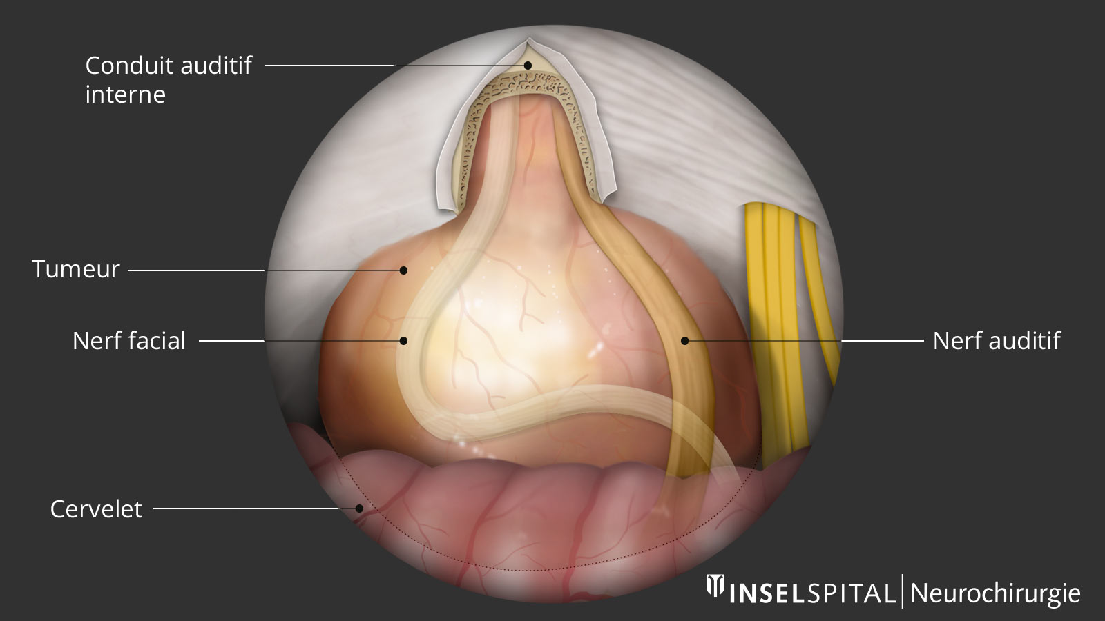 Dessin d'un schwannome vestibulaire du point de vue du chirurgien