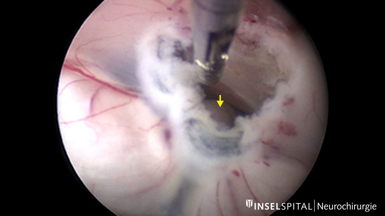 Camera image of an endoscopic third ventriculocisternostomy with a view of the basilar artery