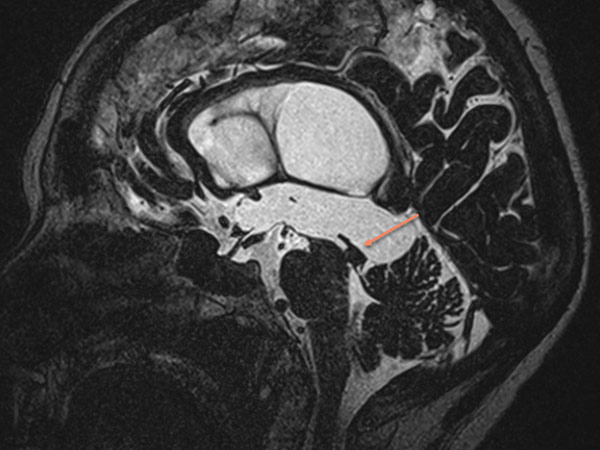 MRI image in CISS-T2 sequence