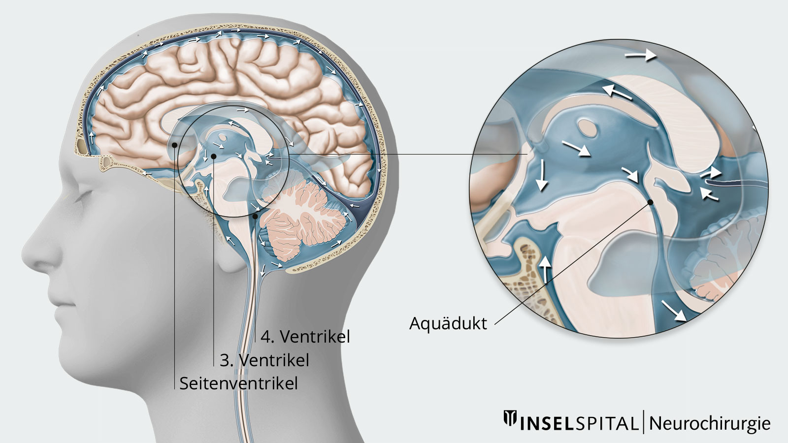 Zeichnung der Hirnventrikel und des Aquädukts zwischen 3. und 4. Hirnventrikel