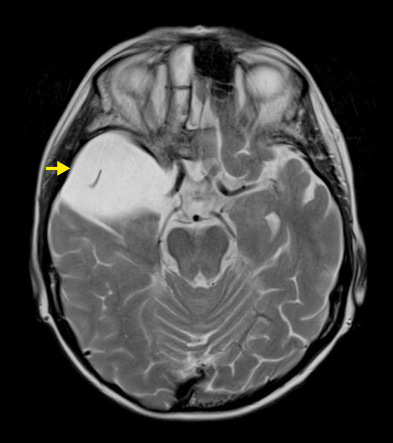 Schädel-MRI mit deutlich sichtbarer Arachnoidalzyste 