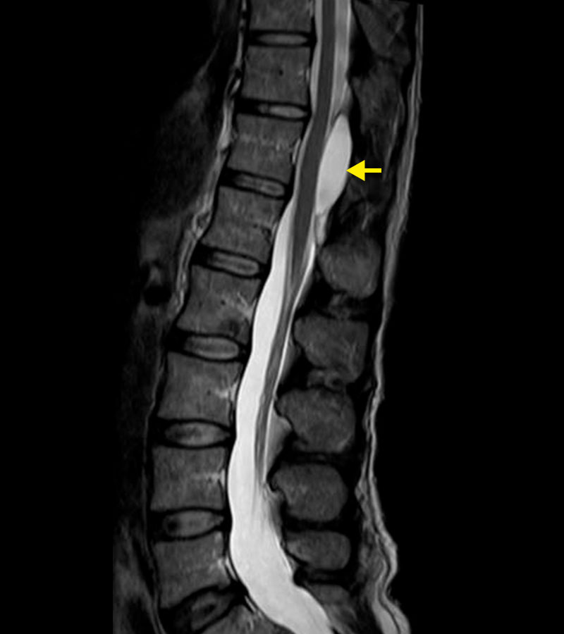 Radiographie de la colonne vertébrale thoracique avec compression de la moelle épinière par un kyste arachnoïdien. 