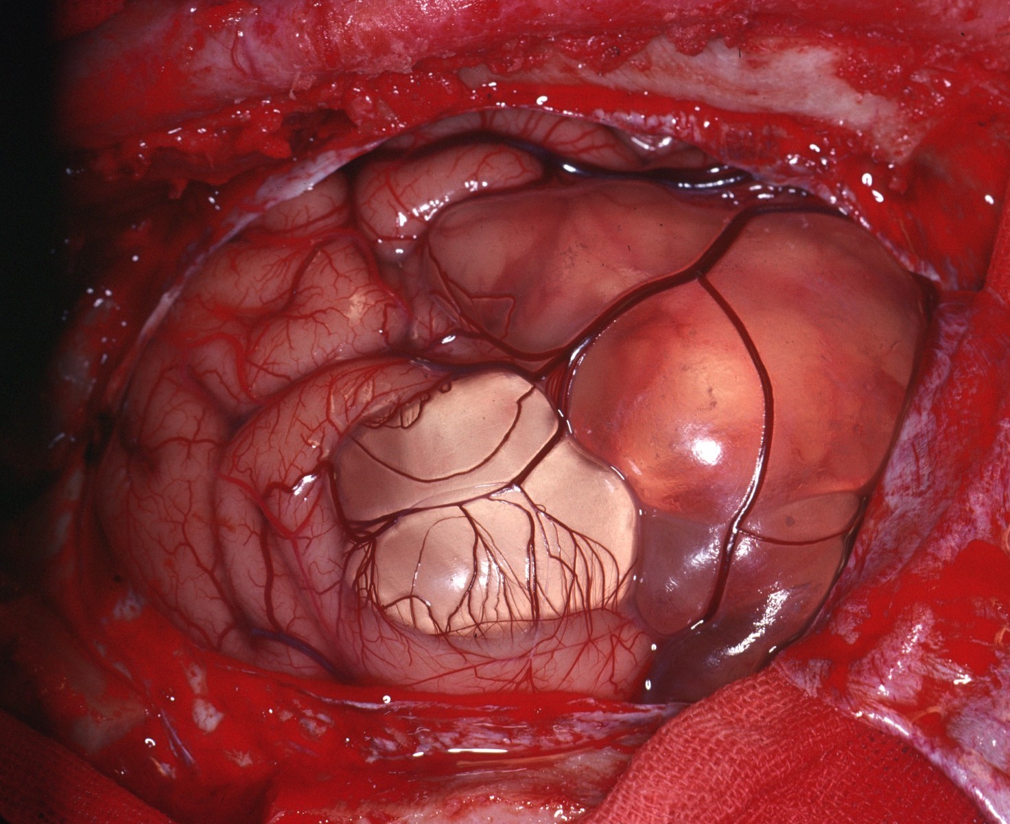 Surgical photo of an arachnoid cyst