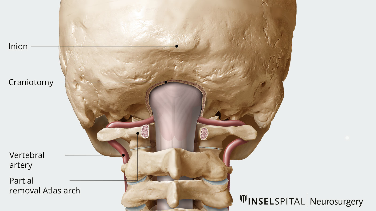 Drawing of bony decompression with partial removal of the atlas arch