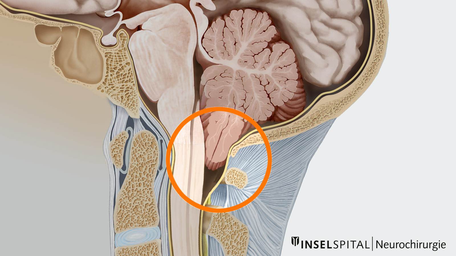 Zeichnung einer Chiari-Malformation I mit Verlagerung der Kleinhirntonsillen