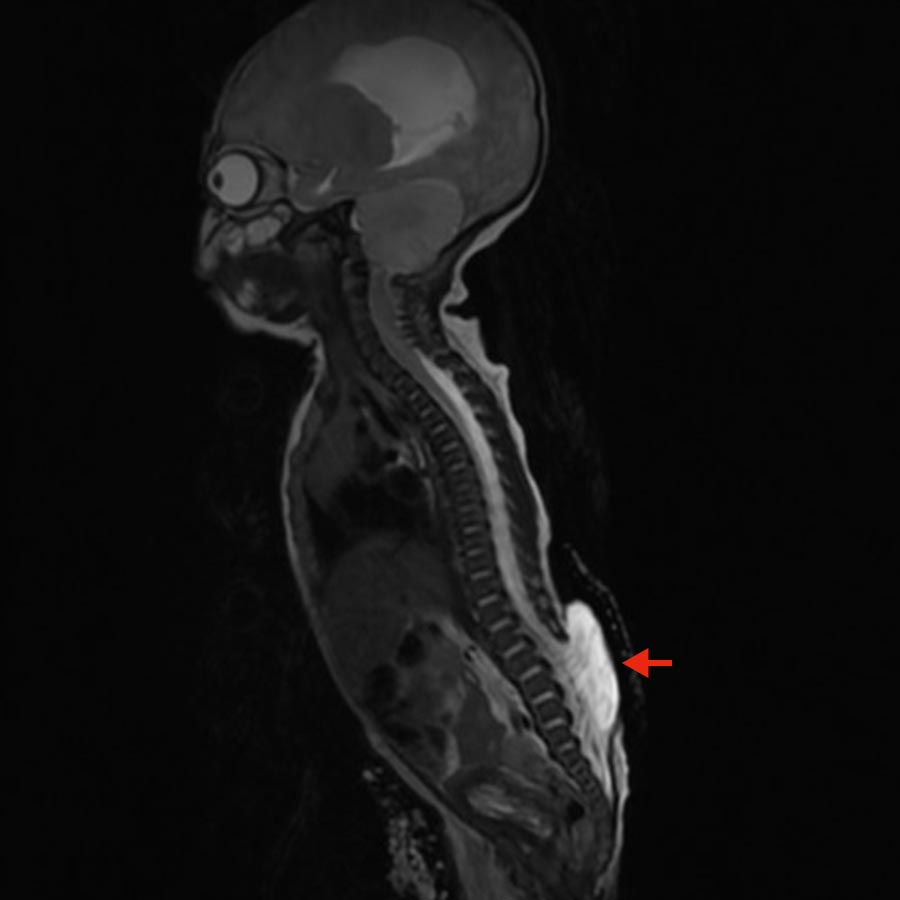 MRI image of a Chiari malformation type II with lumbar myelomeningocele