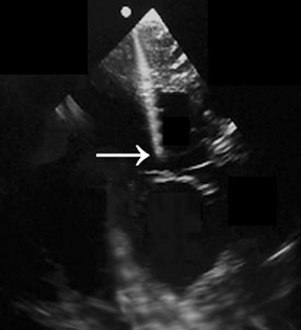 Image échographique d'une pose de shunt VP