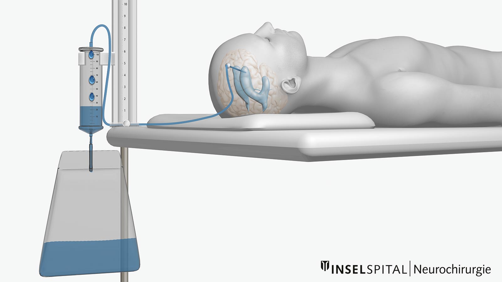 Zeichnung eines Patienten mit externer Ventrikeldrainage