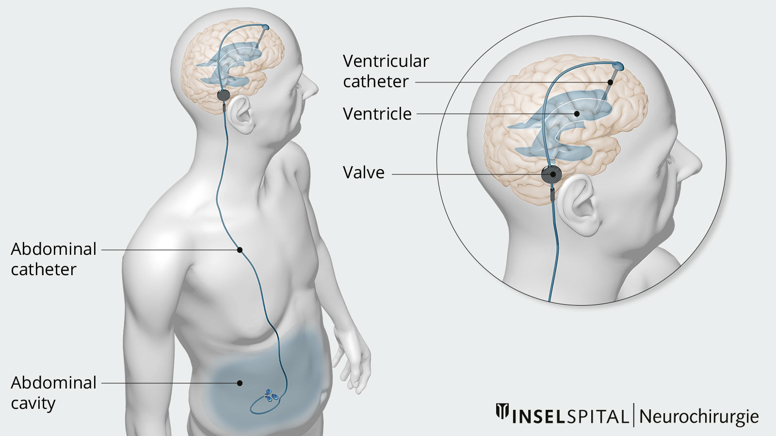 The drawing shows how CSF is fed into the abdominal cavity via a catheter.