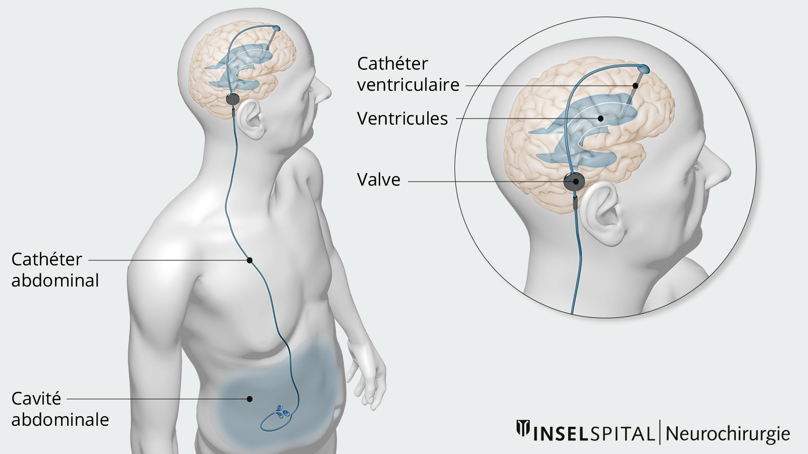 Le dessin montre comment le liquide céphalorachidien est acheminé dans la cavité abdominale par un cathéter.