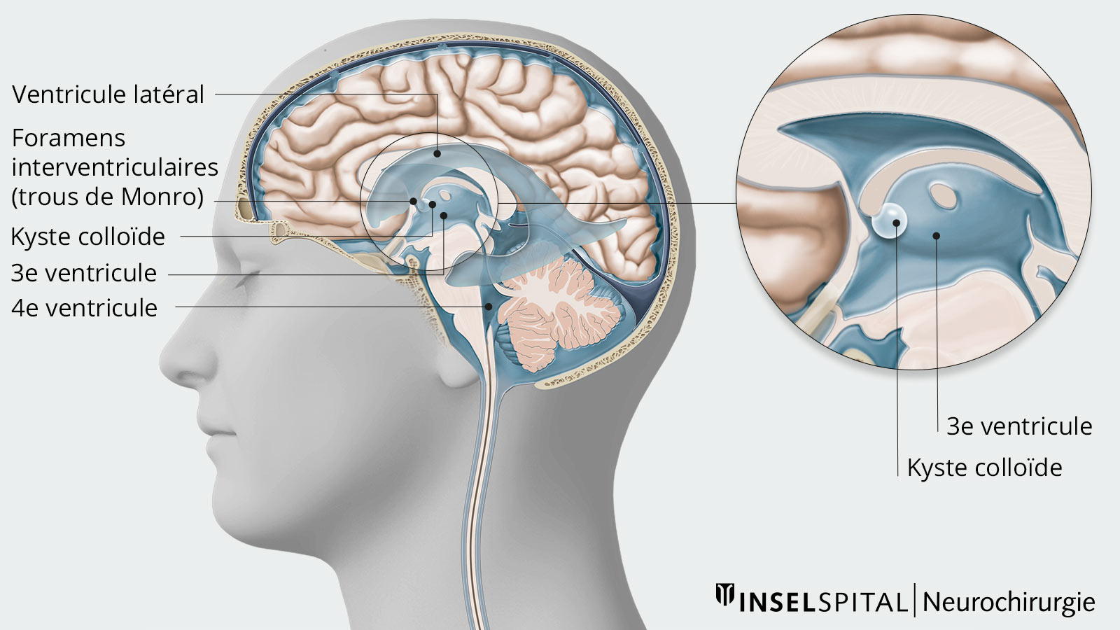 Dessin du système ventriculaire avec kyste colloïde 