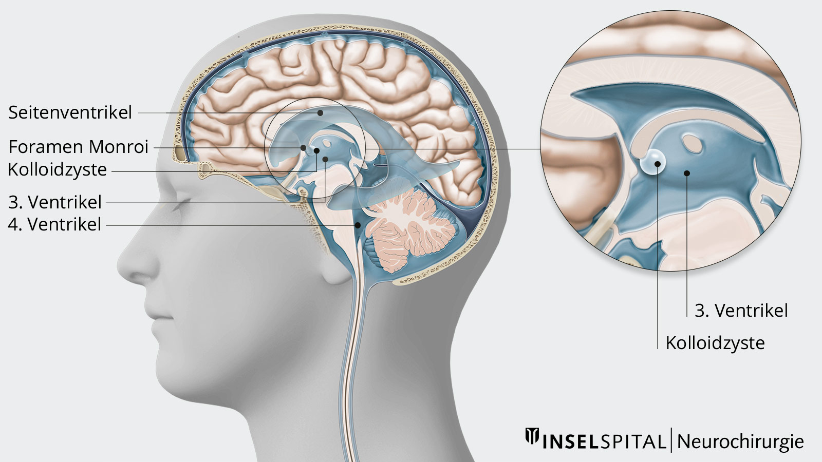 Zeichnung des Ventrikelssystems mit Kolloidzyste