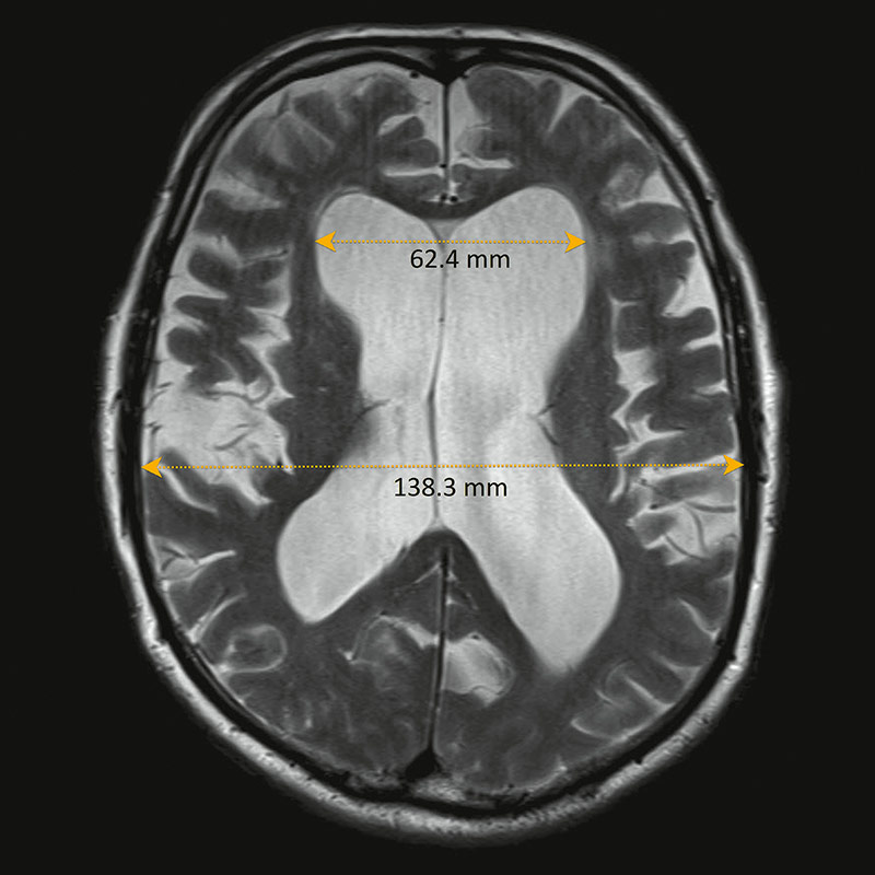 IRM d'une hydrocéphalie à pression normale avec ventricules dilatés