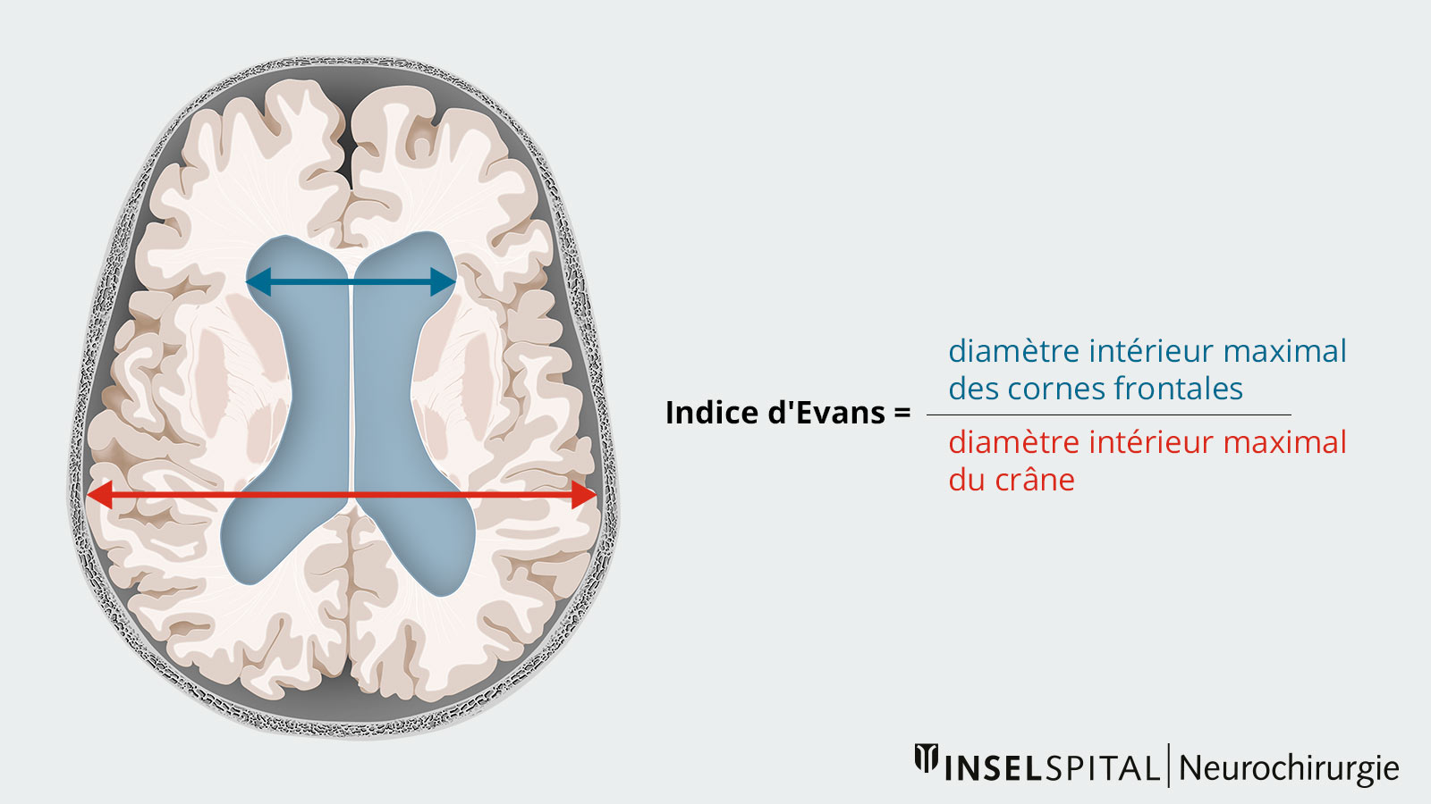 Dessin illustrant l'indice d'Evans