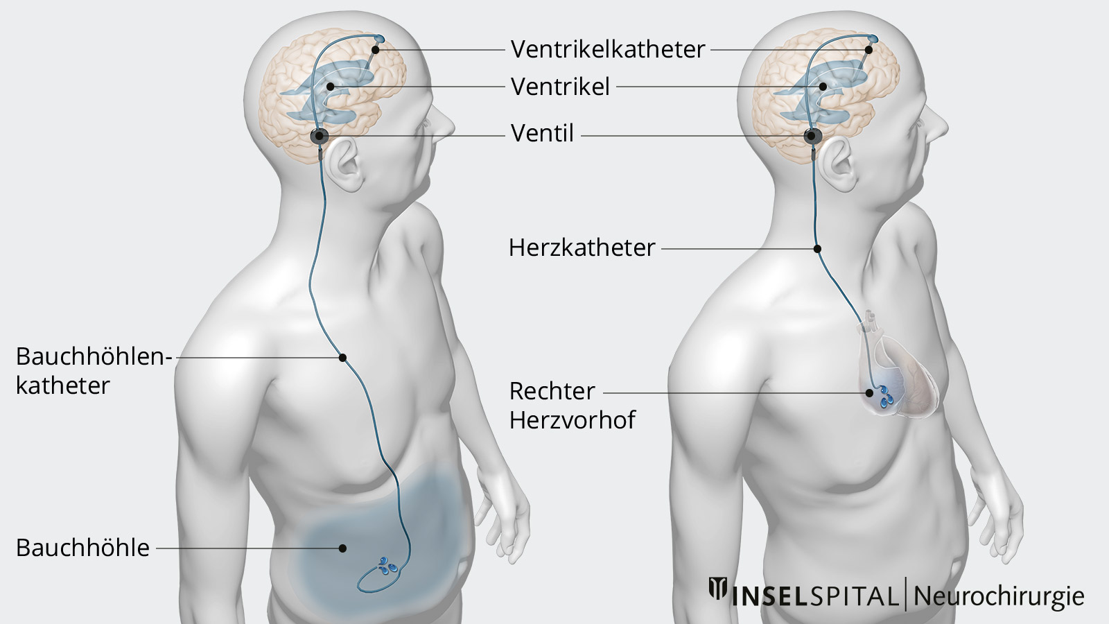 Zeichnung zu VP-Shunt und AV-Shunt