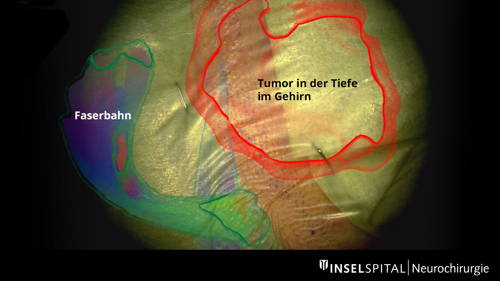 Schädel mit durch AR eingeblendeten farbigen Strukturen von Tumor und Faserbahnen