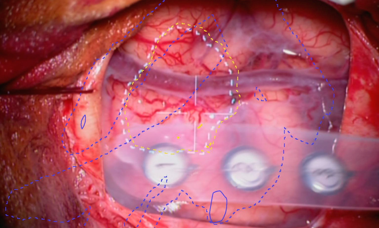 ​Projektion der virtuellen Konturen eines Tumors und der Fasern der wichtigen Bewegungsbahn auf den Kopf des Patienten