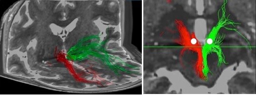 Fiber-Tracking-Aufnahmen vor einer Tiefen Hirnstimulation mit markierten Zielpunkten für die Elektrodenplatzierung