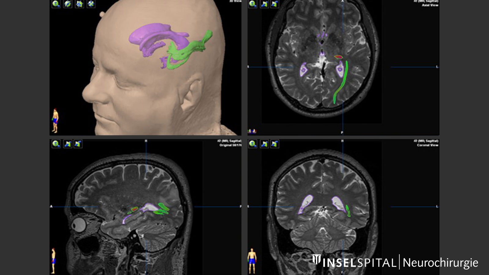 Fiber tracking image of the visual pathway and the ventricular system