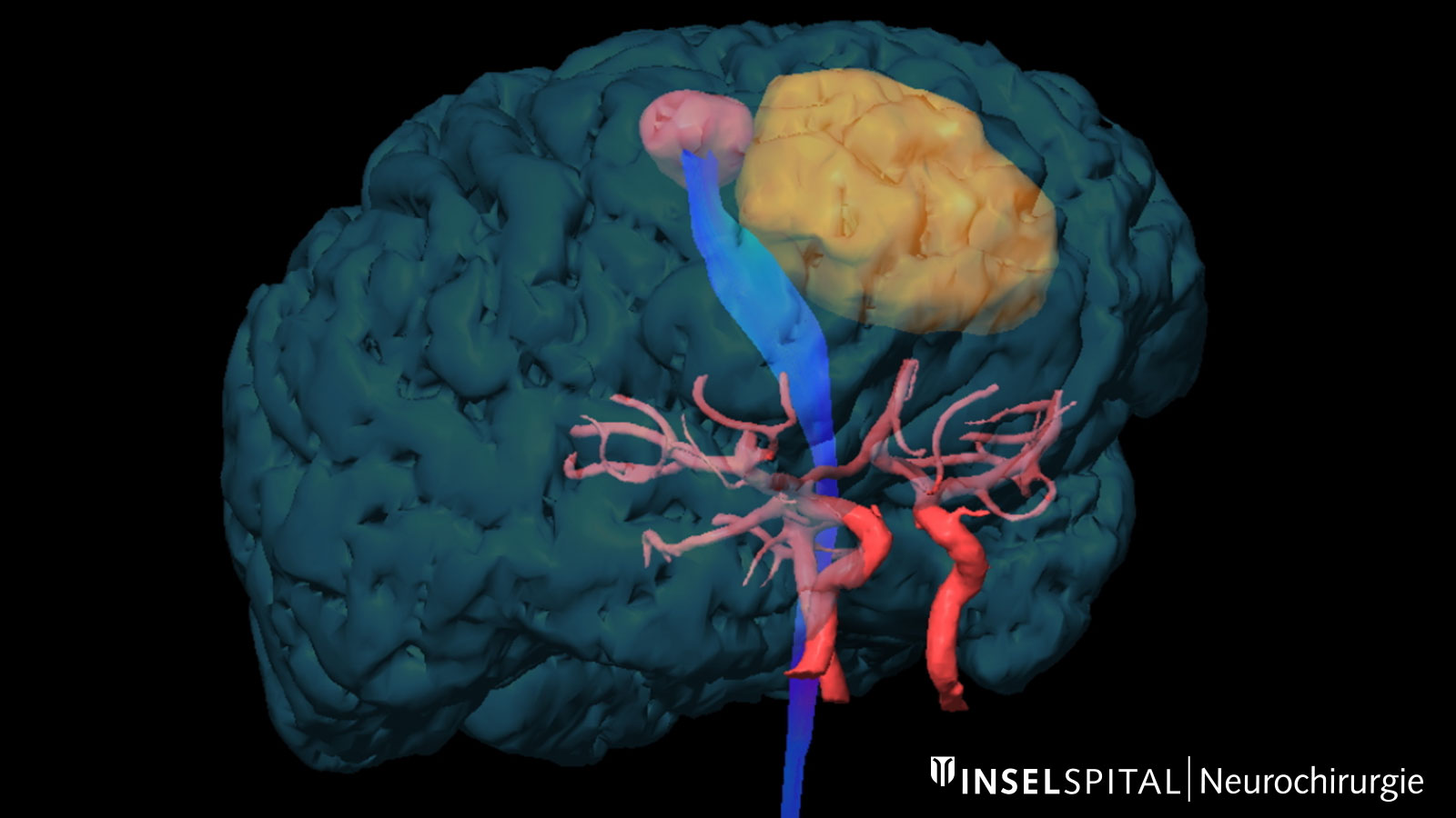 Fiber tracking image of the brain with pyramidal tract, motor cortex and tumor