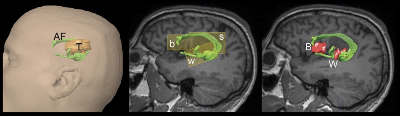 Fiber-Tracking-Aufnahmen des Tumors in Relation zu wichtigen Zentren