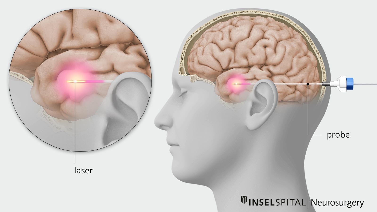 Illustration of laser treatment in the brain: A fine probe uses laser light to heat diseased tissue in a targeted manner. 