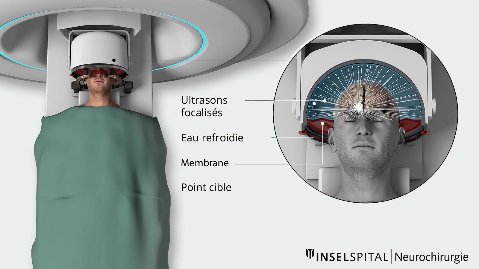 Représentation d’un traitement MRgFUS en IRM : Des ondes ultrasonores focalisées sont dirigées avec précision vers un point ciblé dans le cerveau à travers un casque refroidi.