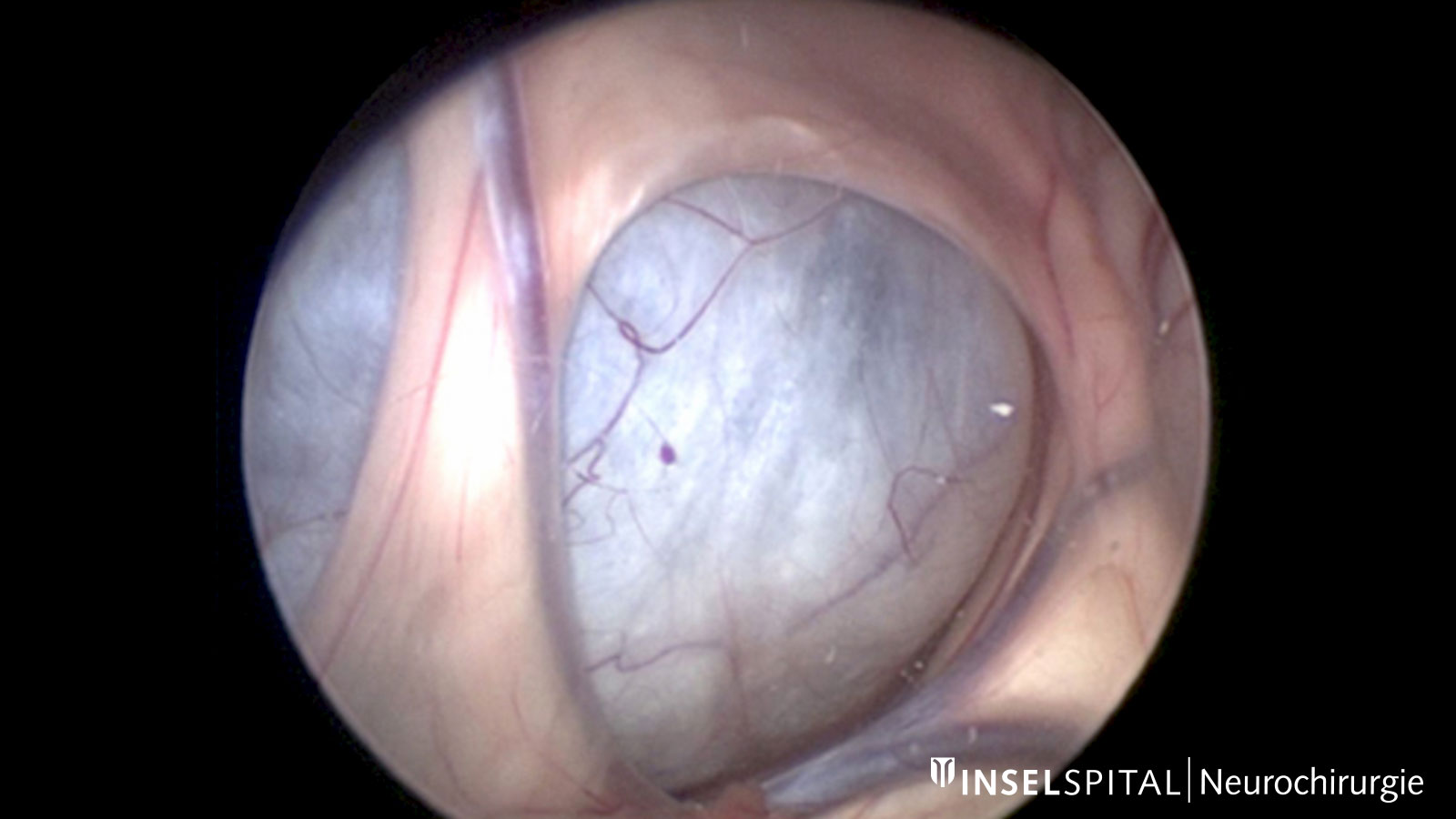 Endoscopic image of an arachnoid cyst